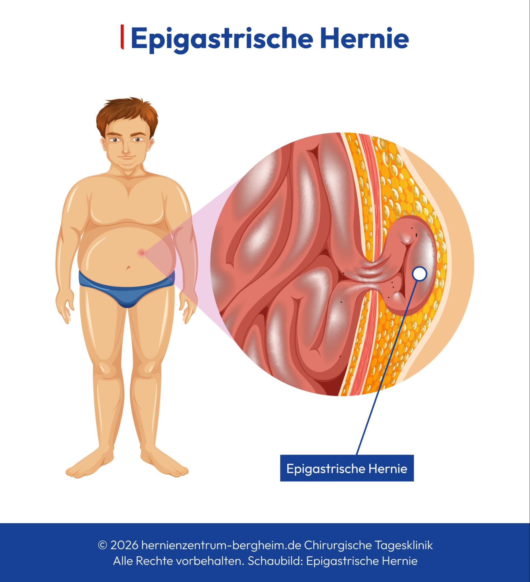 Epigastrische Hernie im Oberbauch schematisch dargestellt